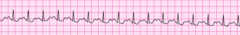 A 53-year-old man has shortness of breath, chest discomfort, and weakness. The patient's blood pressure is 102/59 mm Hg, the heart rate is 230/min, the respiratory rate is 16 breaths/min, and the pulse oximetry reading is 96%. The lead II ECG is displayed below. A patent peripheral IV is in place. What is the next action? A 53-year-old man has shortness of breath, chest discomfort, and weakness. The patient's blood pressure is 102/59 mm Hg, the heart rate is 230/min, the respiratory rate is 16 breaths/min, and the pulse oximetry reading is 96%. The lead II ECG is displayed below. A patent peripheral IV is in place. What is the next action?
