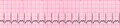 A patient has sudden onset of dizziness. The patient's heart rate is 180/min, blood pressure is 110/70 mm Hg, respiratory rate is 18 breaths/min, and pulse oximetry reading is 98% on room air. The lead II ECG is shown below: A patient has sudden onset of dizziness. The patient's heart rate is 180/min, blood pressure is 110/70 mm Hg, respiratory rate is 18 breaths/min, and pulse oximetry reading is 98% on room air. The lead II ECG is shown below: