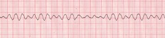 A patient remains in ventricular fibrillation despite 1 shock and 2 minutes of continuous CPR. The next intervention is to A patient remains in ventricular fibrillation despite 1 shock and 2 minutes of continuous CPR. The next intervention is to