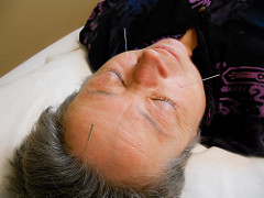 acupuncture acupuncture