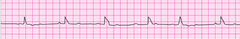 After verifying the absence of a pulse, you initiate CPR with adequate bag-mask ventilation. The patient's lead II ECG appears below. What is your next action? After verifying the absence of a pulse, you initiate CPR with adequate bag-mask ventilation. The patient's lead II ECG appears below. What is your next action?