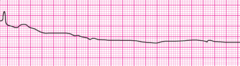 agonal rhythm/asystole agonal rhythm/asystole