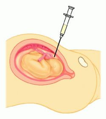 aminocentesis aminocentesis