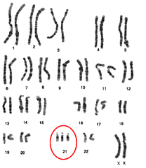 aneuploidy aneuploidy
