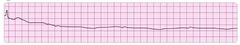 asystole asystole