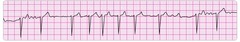 atrial fibrilation atrial fibrilation