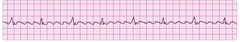 atrial flutter atrial flutter