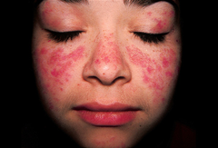 autoimmune diseases autoimmune diseases