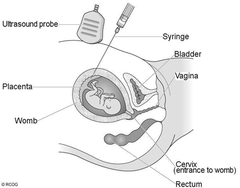 chorionic villus sampling (CVS) chorionic villus sampling (CVS)