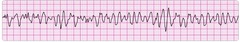 coarse ventricular fibrillation coarse ventricular fibrillation