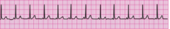 During a pause in CPR, you see this lead II ECG rhythm on the monitor. The patient has no pulse. What is the next action? During a pause in CPR, you see this lead II ECG rhythm on the monitor. The patient has no pulse. What is the next action?