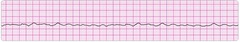 fine ventricular fibrillation fine ventricular fibrillation