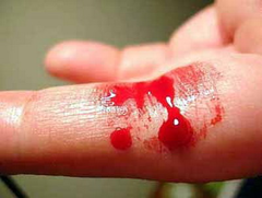 hemophilia hemophilia