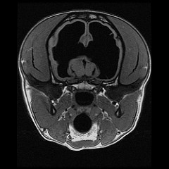 Hydrocephaly Hydrocephaly