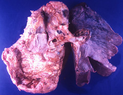 Lungs Lungs