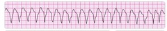 monomorphic ventricular tachycardia monomorphic ventricular tachycardia