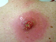 MRSA MRSA
