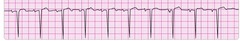 normal sinus rhythm normal sinus rhythm