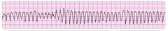 polymorphic ventricular tachycardia - aka torsades polymorphic ventricular tachycardia - aka torsades
