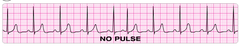 pulseless electrical activity pulseless electrical activity
