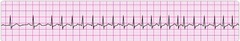 reentry supraventricular tachycardia reentry supraventricular tachycardia