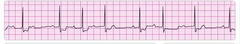 second degree AV block type 1 wenckenbach second degree AV block type 1 wenckenbach