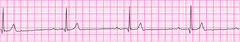 Sinus bradycardia - version 2 Sinus bradycardia - version 2