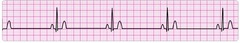 sinus bradycardia sinus bradycardia