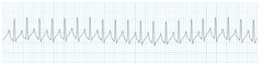 Supraventricular tachycardia Supraventricular tachycardia