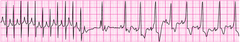 SVT converting to sinus rhythm after adenosine administration SVT converting to sinus rhythm after adenosine administration