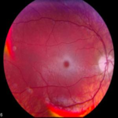 Tay-Sachs disease Tay-Sachs disease