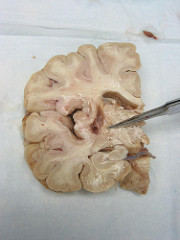 thalamus thalamus