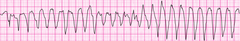 Torsades de pointes Torsades de pointes