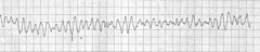 Ventricular fibrillation Ventricular fibrillation