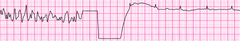 VF with successful defib and resumption of organized rhythm VF with successful defib and resumption of organized rhythm