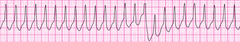 Wide complex tachycardia - version 2 Wide complex tachycardia - version 2
