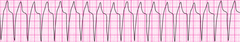 Wide complex tachycardia Wide complex tachycardia