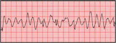 You are monitoring a patient with chest discomfort who suddenly becomes unresponsive. You observe the following rhythm on the cardiac monitor. A defibrillator is present. What is your first action? You are monitoring a patient with chest discomfort who suddenly becomes unresponsive. You observe the following rhythm on the cardiac monitor. A defibrillator is present. What is your first action?