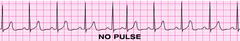 You have completed 2 min of CPR. The ECG monitor displays the lead below (PEA) and the patient has no pulse. You partner resumes chest compressions and an IV is in place. What management step is your next priority? You have completed 2 min of CPR. The ECG monitor displays the lead below (PEA) and the patient has no pulse. You partner resumes chest compressions and an IV is in place. What management step is your next priority?