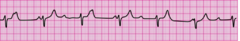 You have completed 2 minutes of CPR. The ECG monitor displays the lead II rhythm below, and the patient has no pulse. Another member of your team resumes chest compressions, and an IV is in place. What management step is your next priority? You have completed 2 minutes of CPR. The ECG monitor displays the lead II rhythm below, and the patient has no pulse. Another member of your team resumes chest compressions, and an IV is in place. What management step is your next priority?